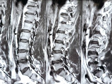 L3-4, L4-5, L5-S1 ve L5-S1 arasındaki omurga alt ve alt bel omurunda Spondylodejeneratif değişimler gösteren manyetik rezonans görüntüleme MRI.