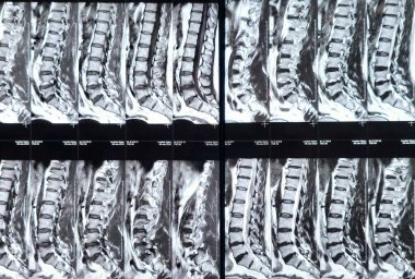 L3-4, L4-5, L5-S1 ve L5-S1 arasındaki omurga alt ve alt bel omurunda Spondylodejeneratif değişimler gösteren manyetik rezonans görüntüleme MRI.