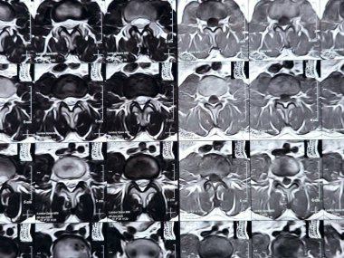 L3-4, L4-5, L5-S1 ve L5-S1 arasındaki omurga alt ve alt bel omurunda Spondylodejeneratif değişimler gösteren manyetik rezonans görüntüleme MRI.