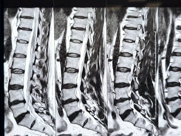 Magnetic Resonance Imaging MRI of the lumbosacral spine shows Spondylodegenerative changes of the lower dorsal and lower lumbar spine, multilevel degenerative disc lesions between L3-4, L4-5, L5-S1