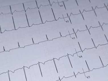 Elektrokardiyogram ya da EKG. 55 yaşında bir erkek için normal EKG. Kalp için elektrokardiyografi, tekrar eden kardiyografi yoluyla kalbin elektriksel aktivitesinin kaydı.