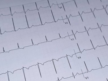 Elektrokardiyogram ya da EKG. 55 yaşında bir erkek için normal EKG. Kalp için elektrokardiyografi, tekrar eden kardiyografi yoluyla kalbin elektriksel aktivitesinin kaydı.