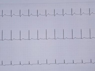 Elektrokardiyogram ya da EKG. 55 yaşında bir erkek için normal EKG. Kalp için elektrokardiyografi, tekrar eden kardiyografi yoluyla kalbin elektriksel aktivitesinin kaydı.
