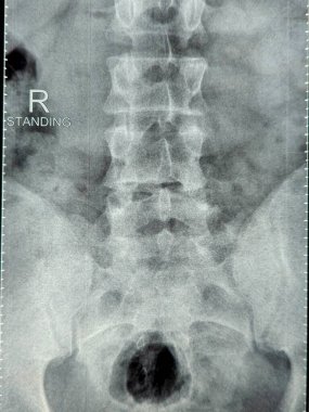 X-ray lumbosacral spine shows straightening of lumbar lordosis due to back muscle spasm, mild rightward lumbar scoliotic deformity, narrowing of L4-L5 disc space, dorsal and lumbar spondylotic changes clipart