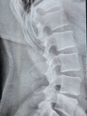 X-ray lumbosacral spine shows straightening of lumbar lordosis due to back muscle spasm, mild rightward lumbar scoliotic deformity, narrowing of L4-L5 disc space, dorsal and lumbar spondylotic changes clipart