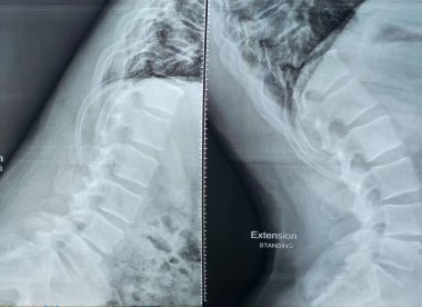 X-ray lumbosacral spine shows straightening of lumbar lordosis due to back muscle spasm, mild rightward lumbar scoliotic deformity, narrowing of L4-L5 disc space, dorsal and lumbar spondylotic changes clipart