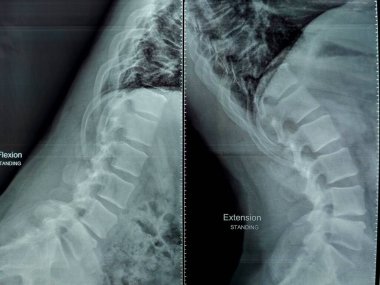 X-ray lumbosakral omurga sırt kası spazmı, hafif sağ bel omurga deformasyonu, L4-L5 disk alanı daralması, sırt ve bel spondilotik değişimlerine bağlı olarak bel lordosisinin düzleştiğini gösteriyor.