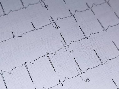 Elektrokardiyogram ya da EKG. 55 yaşında bir erkek için normal EKG. Kalp için elektrokardiyografi, tekrar eden kardiyografi yoluyla kalbin elektriksel aktivitesinin kaydı.