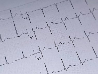 Elektrokardiyogram ya da EKG. 55 yaşında bir erkek için normal EKG. Kalp için elektrokardiyografi, tekrar eden kardiyografi yoluyla kalbin elektriksel aktivitesinin kaydı.