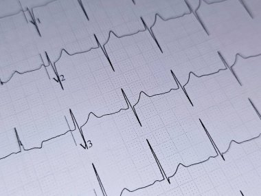 Elektrokardiyogram ya da EKG. 55 yaşında bir erkek için normal EKG. Kalp için elektrokardiyografi, tekrar eden kardiyografi yoluyla kalbin elektriksel aktivitesinin kaydı.