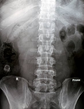 İdrar yolunun dijital hesaplı radyografisi, üst üreterin içinde küçük opak kalküler yoğunluğun, sol hemipelviste hafif kireçsel yoğunluğun, L2 'nin çapraz sürecini kapladığını gösteriyor.