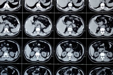 Karın ve pelvis tomografisi sol üst üreterik taşın hafif sırt basıncı etkisi olduğunu gösteriyor. Sağ böbrek kalsiyel taşı, apandistin yakın kısmında kireçlenmiş apandisit.