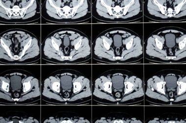 Karın ve pelvis tomografisi sol üst üreterik taşın hafif sırt basıncı etkisi olduğunu gösteriyor. Sağ böbrek kalsiyel taşı, apandistin yakın kısmında kireçlenmiş apandisit.