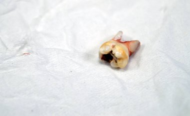 Çekilmiş birincil yaprak döken geçici dişler, insanların büyüme ve gelişimindeki ilk dişler, iltihaplanma ve diş kisti, apse, bir çocuk için diş prosedürü