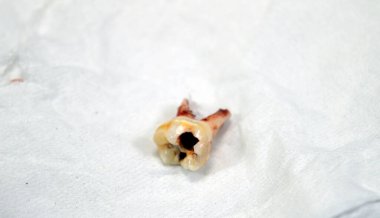 Çekilmiş birincil yaprak döken geçici dişler, insanların büyüme ve gelişimindeki ilk dişler, iltihaplanma ve diş kisti, apse, bir çocuk için diş prosedürü