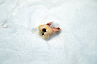 Çekilmiş birincil yaprak döken geçici dişler, insanların büyüme ve gelişimindeki ilk dişler, iltihaplanma ve diş kisti, apse, bir çocuk için diş prosedürü