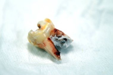 Çekilmiş birincil yaprak döken geçici dişler, insanların büyüme ve gelişimindeki ilk dişler, iltihaplanma ve diş kisti, apse, bir çocuk için diş prosedürü