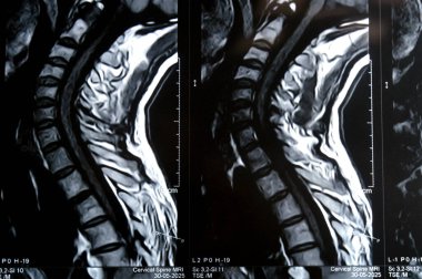 Servikal omurga MR 'ı boyun omurunda dejeneratif dejeneratif değişiklikler olduğunu gösteriyor. Dejeneratif disk lezyonları C3-C4, disk osteophyte kompleksi C4-C5, ve hafif C5-C6.