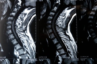 Servikal omurga MR 'ı boyun omurunda dejeneratif dejeneratif değişiklikler olduğunu gösteriyor. Dejeneratif disk lezyonları C3-C4, disk osteophyte kompleksi C4-C5, ve hafif C5-C6.