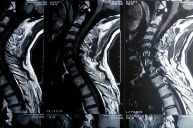 Servikal omurga MR 'ı boyun omurunda dejeneratif dejeneratif değişiklikler olduğunu gösteriyor. Dejeneratif disk lezyonları C3-C4, disk osteophyte kompleksi C4-C5, ve hafif C5-C6.
