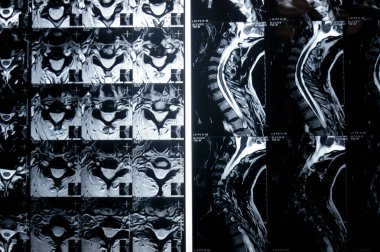 Servikal omurga MR 'ı boyun omurunda dejeneratif dejeneratif değişiklikler olduğunu gösteriyor. Dejeneratif disk lezyonları C3-C4, disk osteophyte kompleksi C4-C5, ve hafif C5-C6.