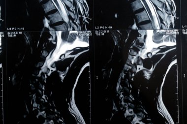 Servikal omurga MR 'ı boyun omurunda dejeneratif dejeneratif değişiklikler olduğunu gösteriyor. Dejeneratif disk lezyonları C3-C4, disk osteophyte kompleksi C4-C5, ve hafif C5-C6.