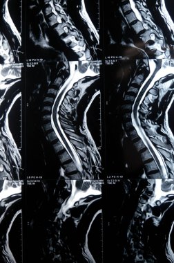 Servikal omurga MR 'ı boyun omurunda dejeneratif dejeneratif değişiklikler olduğunu gösteriyor. Dejeneratif disk lezyonları C3-C4, disk osteophyte kompleksi C4-C5, ve hafif C5-C6.
