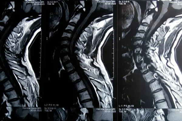 Servikal omurga MR 'ı boyun omurunda dejeneratif dejeneratif değişiklikler olduğunu gösteriyor. Dejeneratif disk lezyonları C3-C4, disk osteophyte kompleksi C4-C5, ve hafif C5-C6.