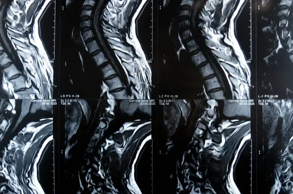 Servikal omurga MR 'ı boyun omurunda dejeneratif dejeneratif değişiklikler olduğunu gösteriyor. Dejeneratif disk lezyonları C3-C4, disk osteophyte kompleksi C4-C5, ve hafif C5-C6.