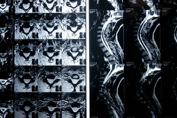Servikal omurga MR 'ı boyun omurunda dejeneratif dejeneratif değişiklikler olduğunu gösteriyor. Dejeneratif disk lezyonları C3-C4, disk osteophyte kompleksi C4-C5, ve hafif C5-C6.