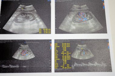 Kahire, Mısır, 12 Haziran 2025: Normal böbrek sonografik muayenesi damarları, patent renal damarları, renal arter stenozu veya parankimatöz şefkat belirtisi yok.