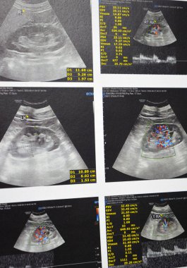 Kahire, Mısır, 12 Haziran 2025: Normal böbrek sonografik muayenesi damarları, patent renal damarları, renal arter stenozu veya parankimatöz şefkat belirtisi yok.