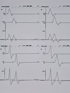 Nöro iletim çalışmaları hem alt kollar hem de duyusal sinirler için elektrofizyolojik çalışmalar gösteriyor ki, proksimal ya da distal kapana kısılma belirtisi yok ve çevresel nöropati belirtisi de yok.