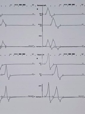 Nöro iletim çalışmaları hem alt kollar hem de duyusal sinirler için elektrofizyolojik çalışmalar gösteriyor ki, proksimal ya da distal kapana kısılma belirtisi yok ve çevresel nöropati belirtisi de yok.