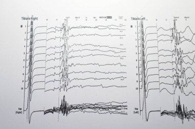 Nöro iletim çalışmaları hem alt kollar hem de duyusal sinirler için elektrofizyolojik çalışmalar gösteriyor ki, proksimal ya da distal kapana kısılma belirtisi yok ve çevresel nöropati belirtisi de yok.