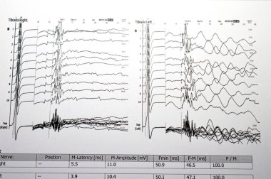 Nöro iletim çalışmaları hem alt kollar hem de duyusal sinirler için elektrofizyolojik çalışmalar gösteriyor ki, proksimal ya da distal kapana kısılma belirtisi yok ve çevresel nöropati belirtisi de yok.