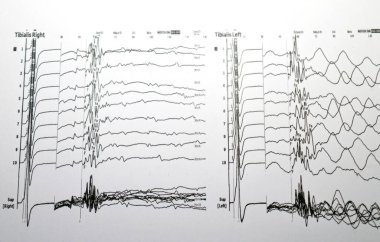 Nöro iletim çalışmaları hem alt kollar hem de duyusal sinirler için elektrofizyolojik çalışmalar gösteriyor ki, proksimal ya da distal kapana kısılma belirtisi yok ve çevresel nöropati belirtisi de yok.