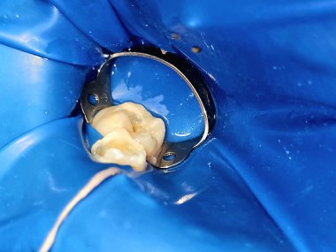 Lastik baraj, pulpotomi ve birincil dişin temizlenmesi ile izole edilmiş iki diş için bir diş prosedürü, ve diğer ikincil kalıcı dişin boşluğunu temizlemek, seçici odaklanma