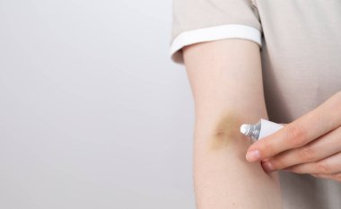 Birisi şifa kremi sürmüş, hematoma merhem sürmüş, enjeksiyondan sonra çürük, metal tüpten kan örneği almış. Tedavi. İğne sonrası damar iltihabı. Metin için uzayı kopyala. Yatay düzlem