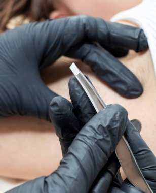 Kapalı Dermatolog Saçını Cımbızla Kaldırdı Alt Kolları, Elektroliz Prosedürü, Güzellik Salonunda Elektrik Epilasyonu. Saç Temizleme Tedavisi. Dikey düzlem. Yüksek kalite fotoğraf.