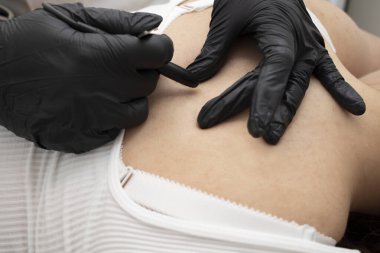 Beyaz hastanın sırtında saç çıkarma elektrolizi prosedürü uygulayan bir dermatolog, Güzellik Salonunda elektrik patlaması. Yatay düzlem. Otantik Yüksek Kaliteli Fotoğraf