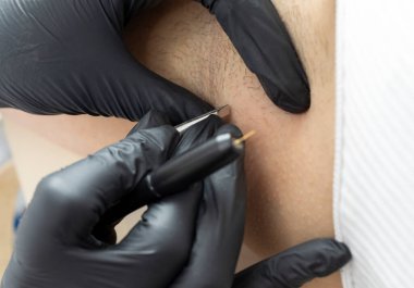 Cımbız, elektroliz prosedürü, Güzellik Salonunda Elektrik Epilasyonu ile Hastaların Koltuk Altında Saç Çeken Kapalı Dermatolog. Saç Temizleme Tedavisi. Yatay düzlem. Yüksek kalite fotoğraf