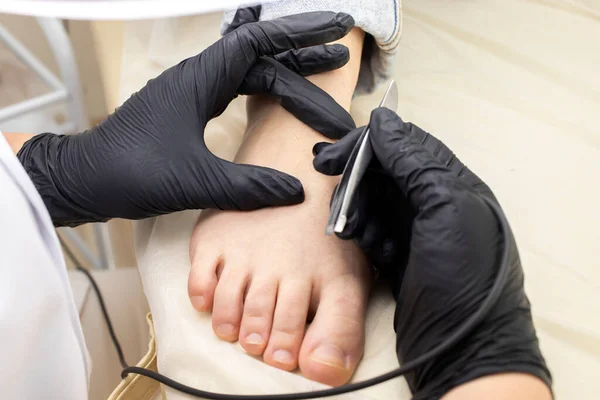 Dermatólogo Recortado Haciendo Depilación Procedimiento Electrólisis Los Dedos Los Pies — Foto de Stock
