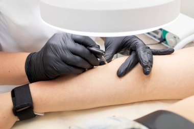 Hirsutizm, Kapalı Saç Temizleme Süreci, Beyaz Kadın 'ın Elindeki Elektroliz, Güzellik Salonundaki Elektrikli Epilasyon. Yatay düzlem. Otantik Yüksek Kaliteli Fotoğraf