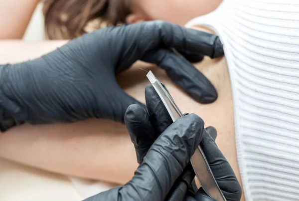 Closeup Dermatologist Holds Removed Hair Tweezers Patients Underarm Electrolysis Procedure — Stock Photo, Image