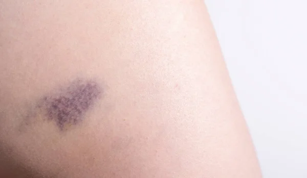 Hematoma Púrpura Azul Primer Plano Hematoma Muslo Cadera Después Trauma — Foto de Stock