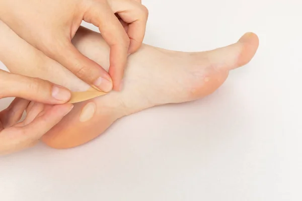 Person Applies Adhesive Plaster On Foot Calluses, Skin Corns on Heel and Phalange of Toe. Water Blister Disease On Feet. Painful Callosity Before Treatment. Closeup Horizontal Plane. Copy Space
