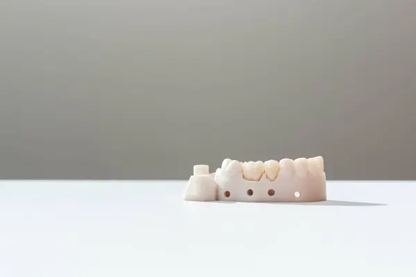 Teeth Crowns And Bridge Equipment Model Shows Fix Restoration, Prosthodontics Or Prosthetic. Inserting Or Placing Procedure Of Ceramic Dental Crown. Horizontal View, Space For Text. High quality photo