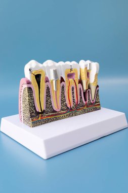 Diş implantı, köprü ya da Crown Model mavi arka planda, kopyala uzay. Kukla Taklit İnsan Çenesi Ağız Takma Dişleri. Metal Peg Protezi. Dikey düzlem. Yüksek kalite fotoğraf