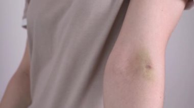Yakın plan kadın eli hematoma, enjeksiyondan sonra çürük, gri zeminde kan örneği. Yaralanma, iğne sonrası damar iltihabı. Yatay düzlem. Yüksek Kalite Video
